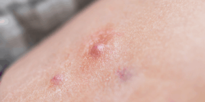 Photo of pimple for article about hidradenitis